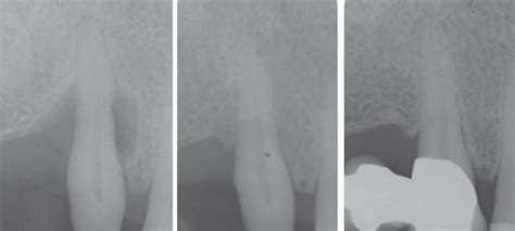 Periodontal bone grafting: The regenerative approach