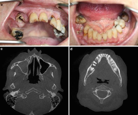 Jaw Osteonecrosis Treatment