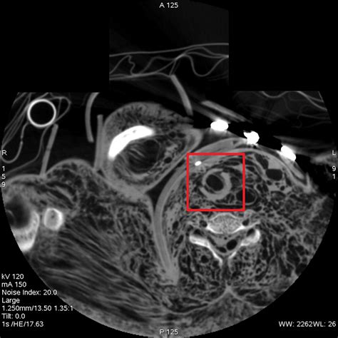 Postmortem Ct Angiography Compared With Autopsy A Forensic Multicenter