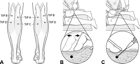 The Effects Of Myofascial Trigger Point Injections On Nocturnal Calf Cramps American Board Of