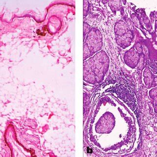 Shows Typical Features Of A Mature Cystic Teratoma Cyst Wall Being