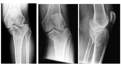 Insights Into Complex Tibial Plateau Fractures Vanderbilt Discover