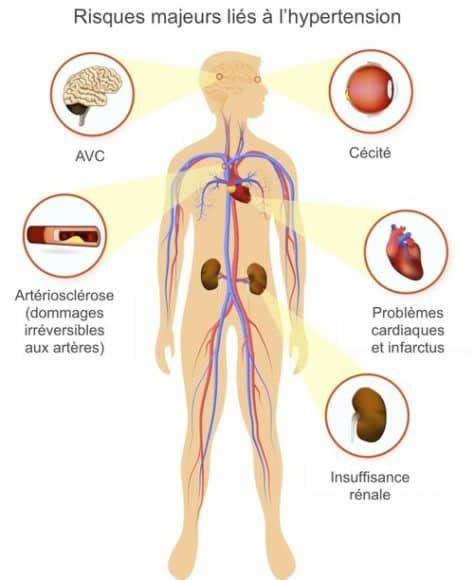 Comprendre L Hypertension Art Rielle Hta Institut Amelis