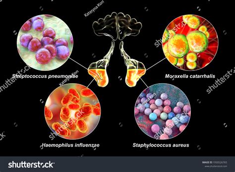 Anatomy Rhinosinusitis Bacteria That Cause Sinusitis Stock Illustration