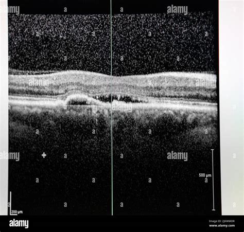 Macular Edema Oct