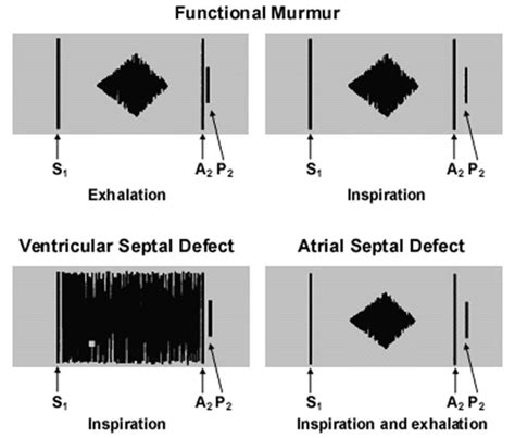 Still's murmur definition, Still's murmur description & diagnosis