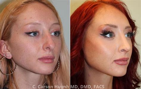 Rhinoplasty Case 3173 Radiance Surgery Aesthetic Medicine