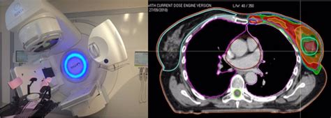 SEOR ensalza la radioterapia en el cáncer de mama por su avance hacia