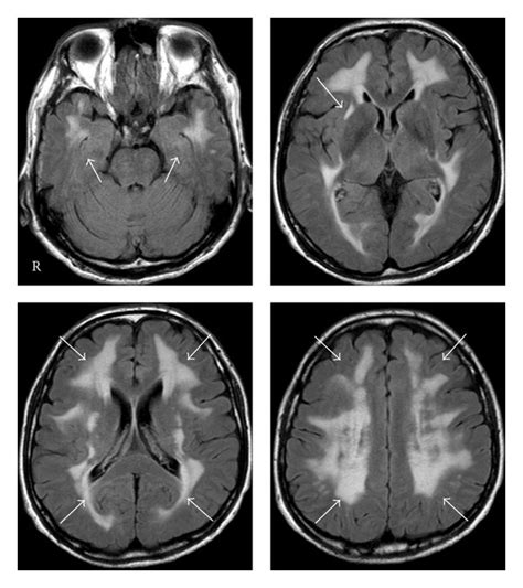 Magnetic Resonance Images And Magnetic Resonance Angiograms A Fluid