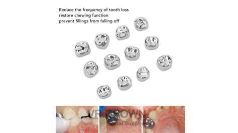 Exploring Alternatives to Dental Crowns: Is There a Better Way? - Pediatric Crowns Factory