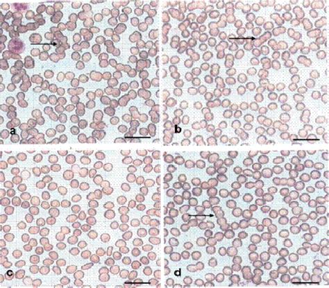 Figure 1 From The Decrease Of Rouleaux Formation Of Red Blood Cells In