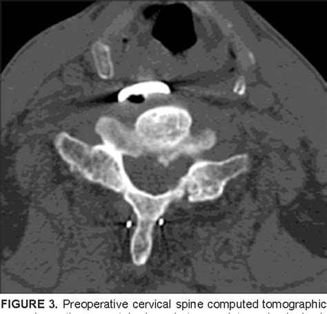 Figure From Delayed Esophagus Perforation After Anterior Cervical