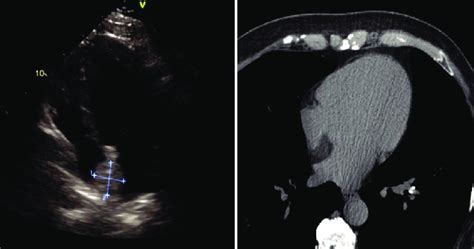 Lipomatous Hyper Trophy Of The Interatrial Septum At Transthoracic