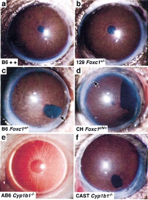 Figure From Anterior Segment Dysgenesis And The Developmental