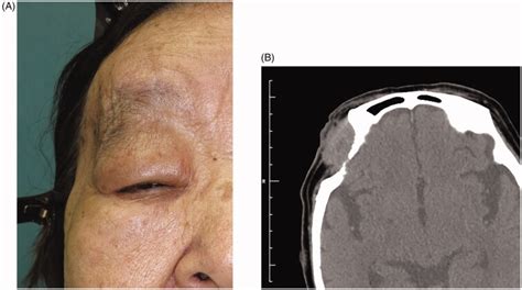 Cranial Dermoid Cyst With Long Term Development Treated By Ethanol