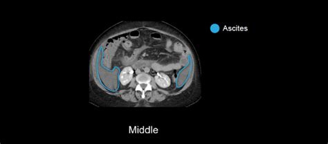 Abdominal Ct Peritoneal Cavity • Litfl • Radiology Library