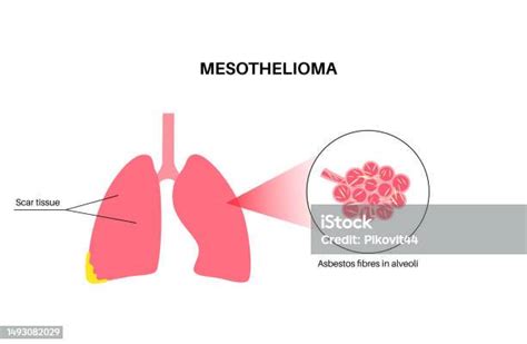 Mesothelioma Cancer Disease Stock Illustration Download Image Now