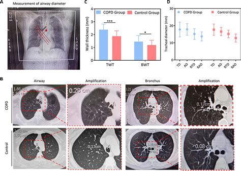 Abhd A Candidate Gene Regulating Airway Remodeling In Copd Copd