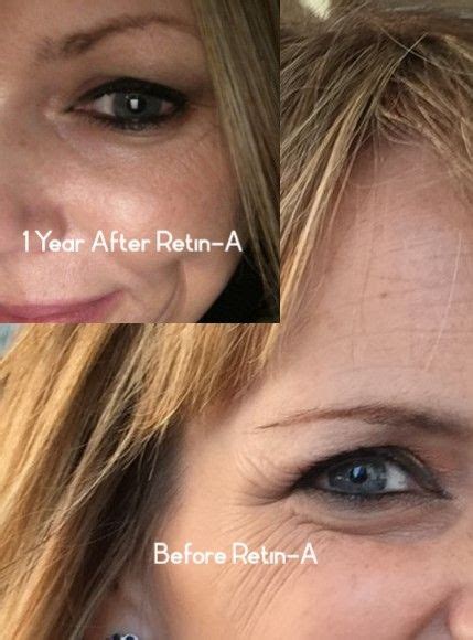 How To Use Retin A For Wrinkles Without Peeling Tretinoin No