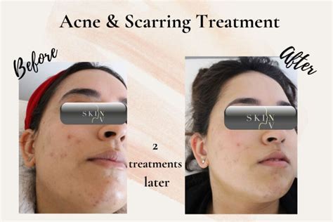 How To Remove Acne Scars Skin Nv Clinic