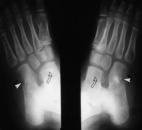 Talocalcaneal Coalition Mri