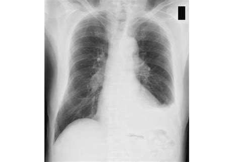 Thoracentesis Best Practices Slideshow