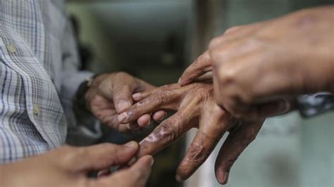 Penyakit Kusta Paling Banyak Menyerang Penduduk Pantai Ini Titik Titik