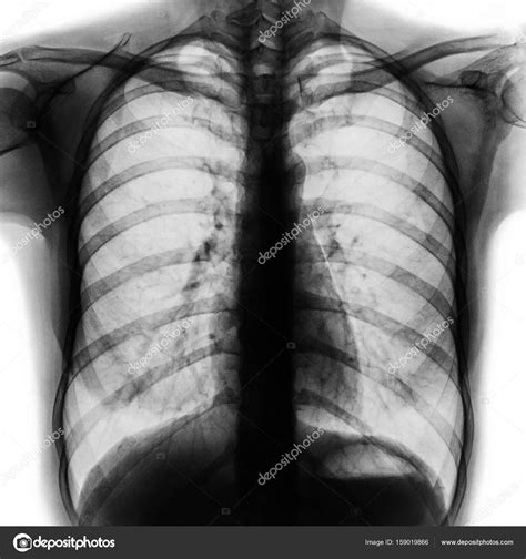 Film Chest X Ray Pa Upright Show Normal Human Chest Stock Photo By