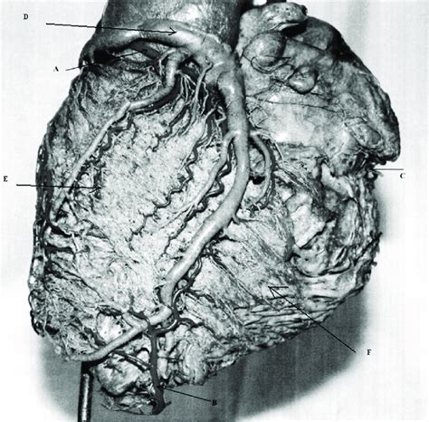 Left Posterior Ventricular Artery