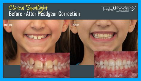 Tri Valley Orthodontics Clinical Spotlight Headgear Treatment Before