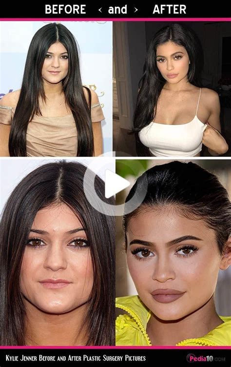 Old Kylie Jenner Lips And Faces Plastic Surgery Before And After Pic