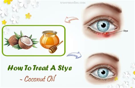 26 Ways How To Treat A Stye On Eyelid & Inside Eye Fast At Home