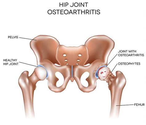 Osteoarthritis of the Hip and Hip Replacement Surgery – Dr Willem ...