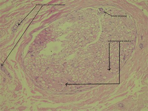 Examined Section Of Sural Nerve Biopsy In Hande Staining Showed Onion