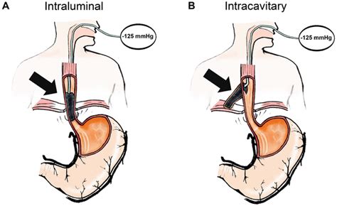 Successful Closure Of Defects In The Upper Gastrointestinal Tract By