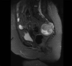 Sagittal Magnetic Resonance Imaging Mri Of The Pelvis Showing A