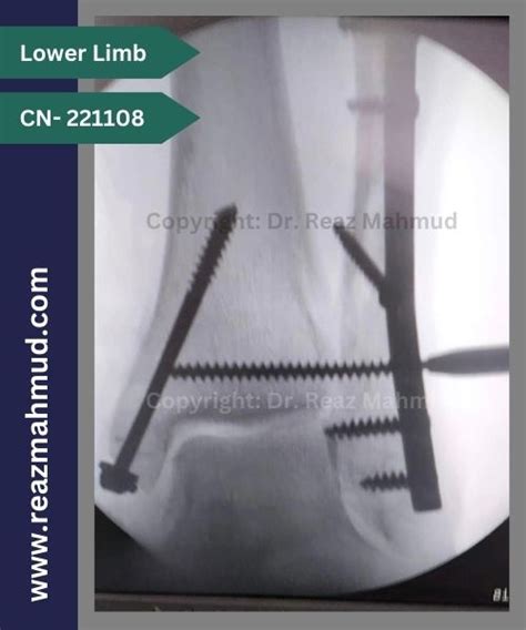 Trimalleolar Fracture | ORIF [CN-221108] - Dr. Reaz Mahmud