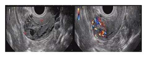 A Color Doppler Transvaginal Sonography Of The Transverse View Of The