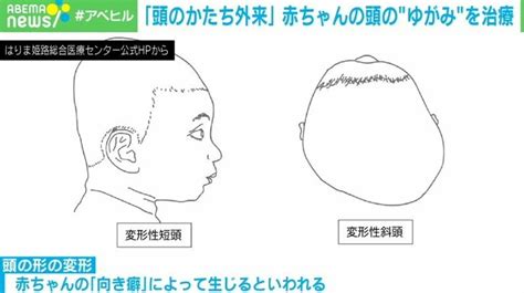 頭の変形を専門に扱う“頭のかたち外来” 費用は数十万円 成長で改善？治療したほうがいい？判断の難しさも 国内 Abema Times