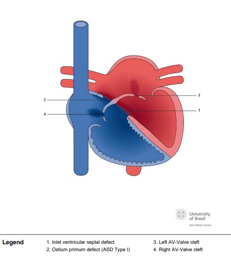 Complete Atrioventricular Septal Defect AVSD Perfusfind