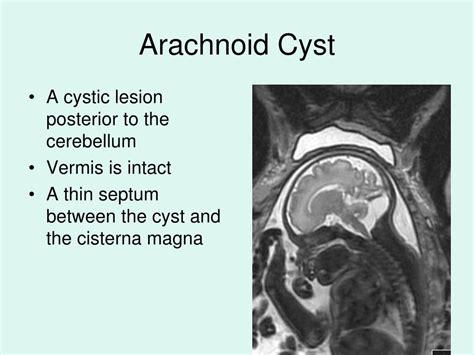 Posterior Fossa Arachnoid Cyst MRI