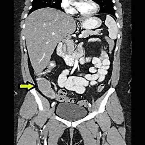 Abdominal Ct Scan Showing Ileoileal Intussusception With A Lead Point