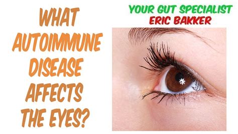 What Autoimmune Disease Affects The Eyes Youtube