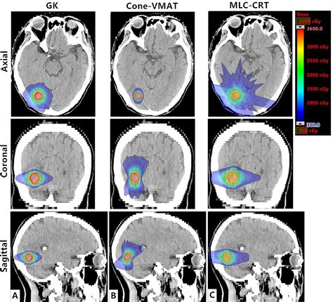 Frontiers Dosimetric Comparison Treatment Efficiency Estimation And