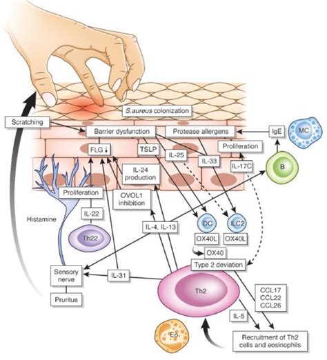 Irritant Contact Dermatitis Pathophysiology