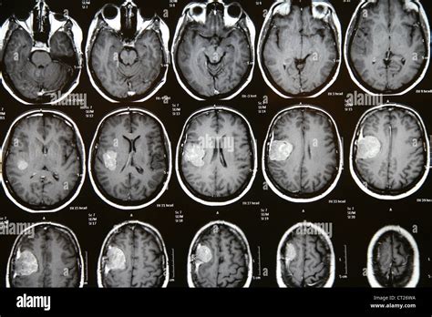 Mri meningioma hi-res stock photography and images - Alamy