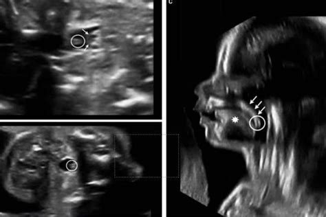 Diagn Stico Prenatal De Paladar Hendido Mediante Ultrasonograf A D