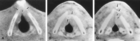 A Pretreatment Ct Scan Of A Patient With A T2 Glottic Carcinoma Shows