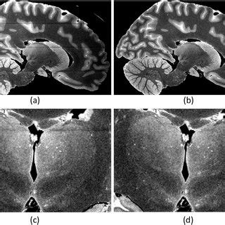 A Sample Sagittal Slice Of Ex Vivo Mri Scan Of Case Nhl B