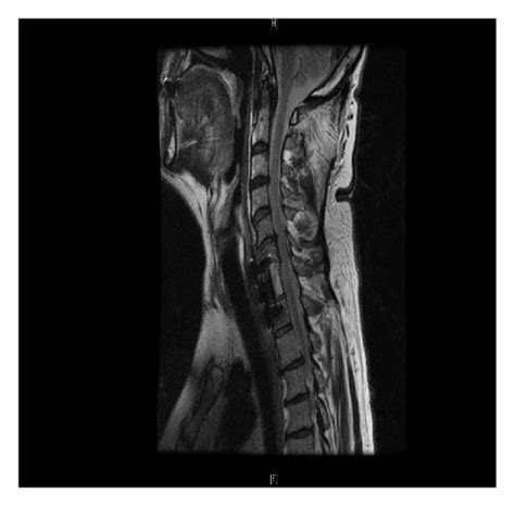 A T2 Weighted Sagittal Image Of The Cervicothoracic Spine Illustrates